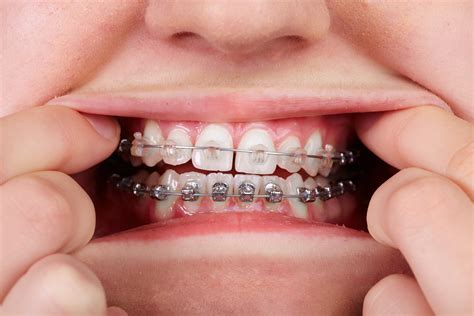 metal orthodontic brackets|metal braces with clear bands.